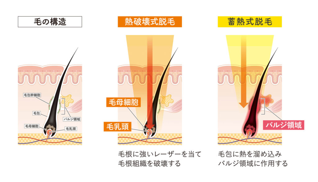 蓄熱式と熱破壊式の違い